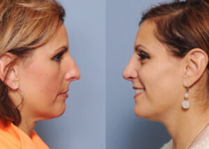 Rhinoplasty Candidate